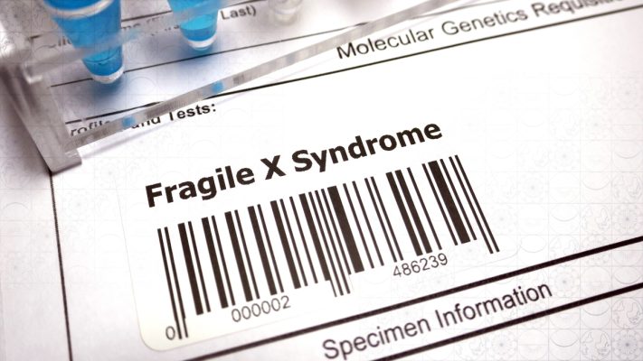 anh bia hoi chung fragile x